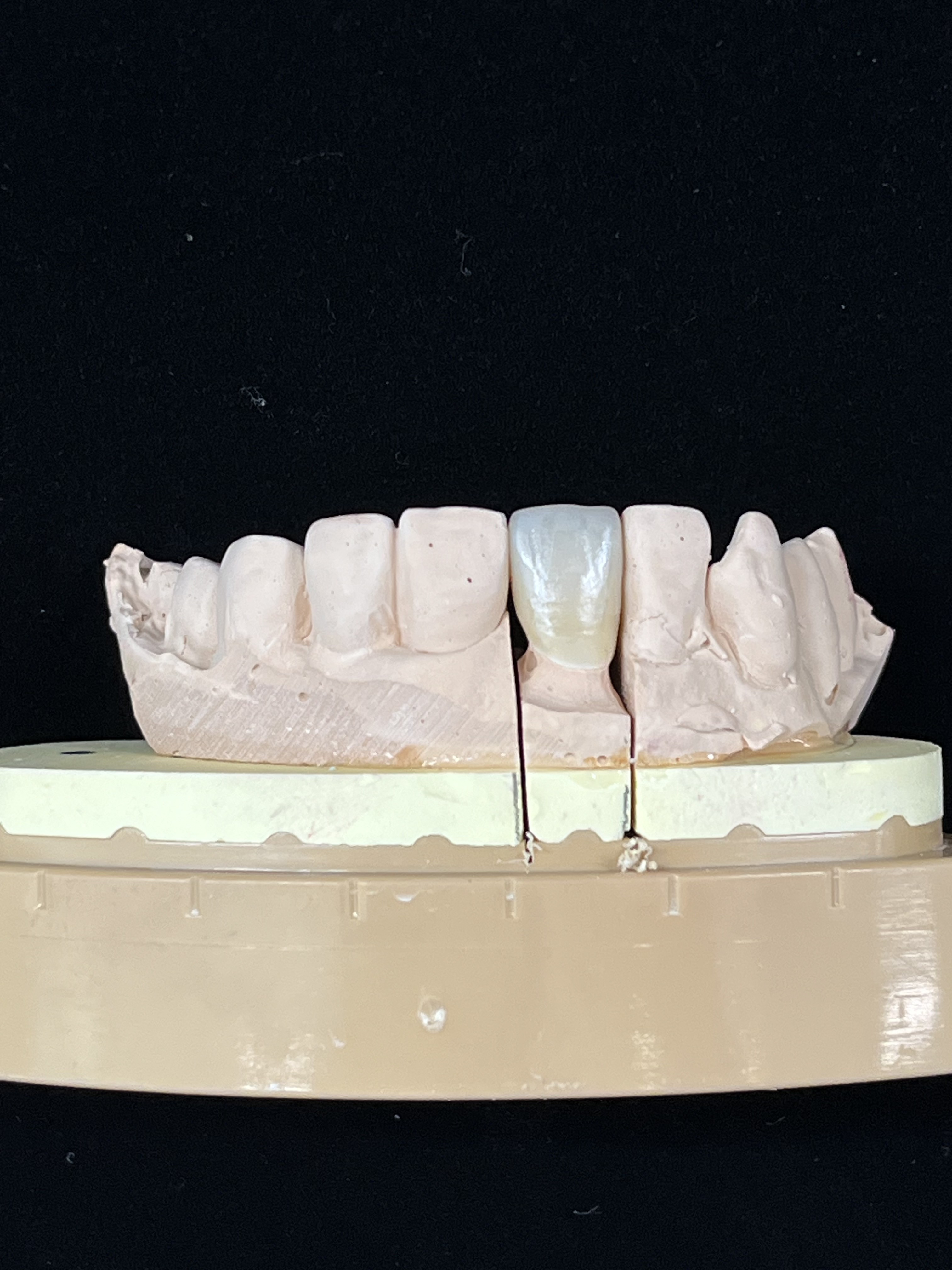 전치부 크라운 정면